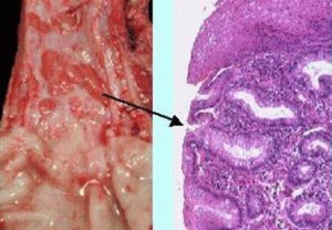 Reflux-oesofagitis-graden: 1, 2, 3 en 4, hun symptomen