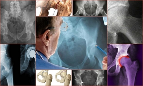 Hüfte Osteoporose - Symptome