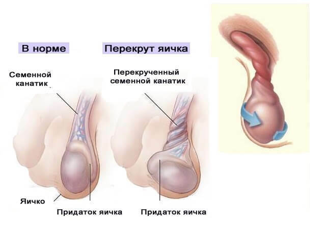 Tumors of the scrotum - classification, causes, diagnosis and symptoms