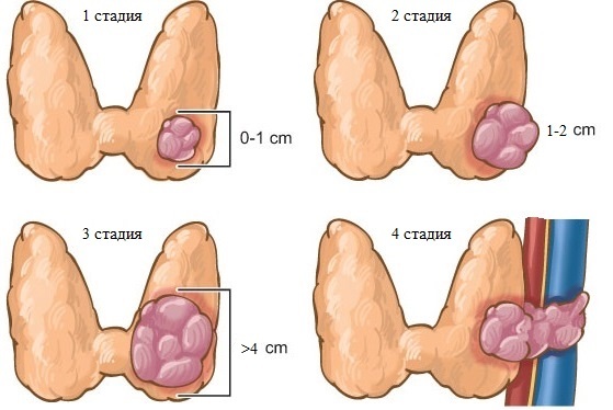 Papillary thyroid cancer: causes, operation, prognosis