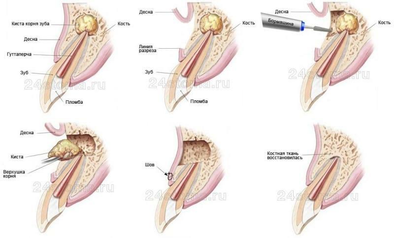 Tooth extraction with cyst effect