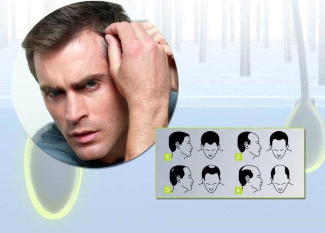 Hur att dölja de kala områden: hur man väljer en frisyr, komuflyazhnye medel, experter rekommenderar