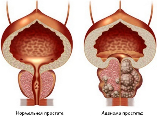 Options for surgical treatment of prostate adenoma