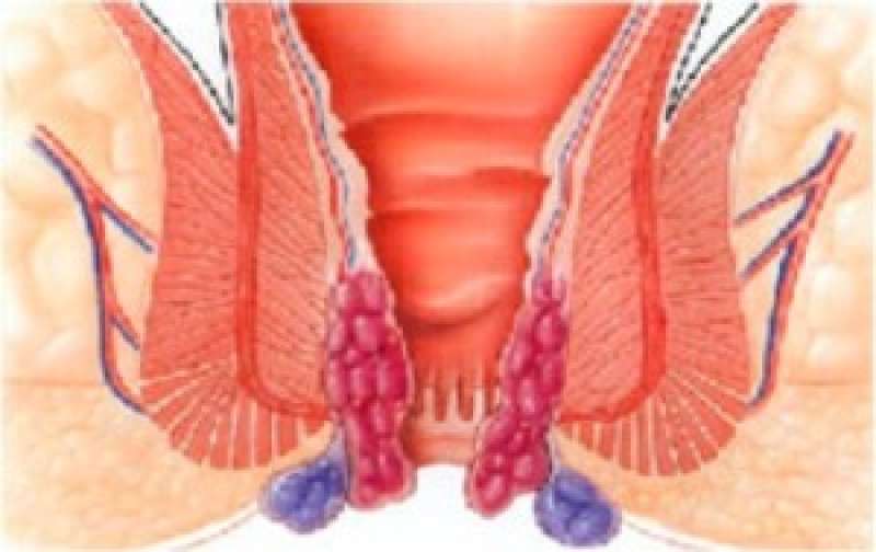 Hemorroider komplisert av trombose