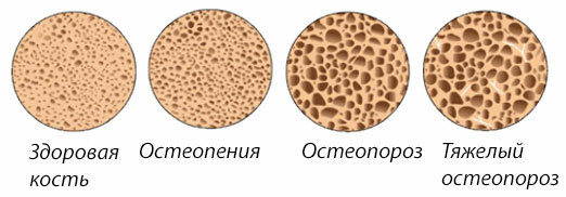 Osteopenia and osteoporosis