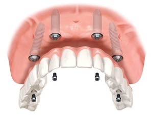 zubní protéza