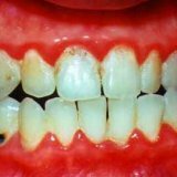 Hoe te behandelen bloeden tandvlees