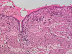 Chronische cholecystitis