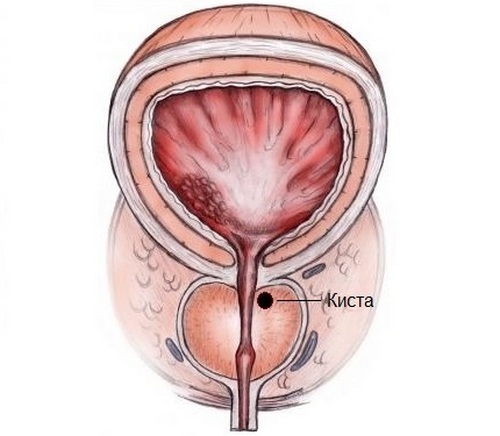 Cyst of the prostate: symptoms and treatment