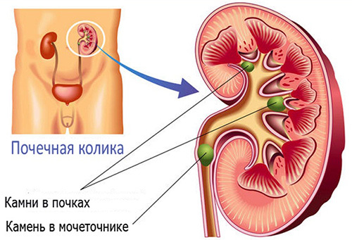 The cause of renal colic