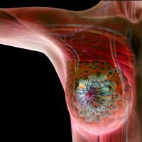 Chemotherapy for Breast Cancer