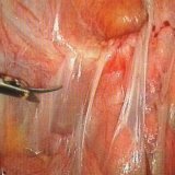 Surgical intervention with adhesions