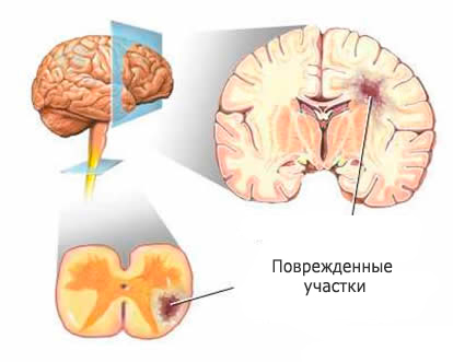 Brain-multiple sclerosis