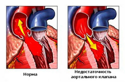 Aortisk ventil insufficiens