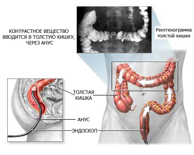 Irrigoscopia del intestino