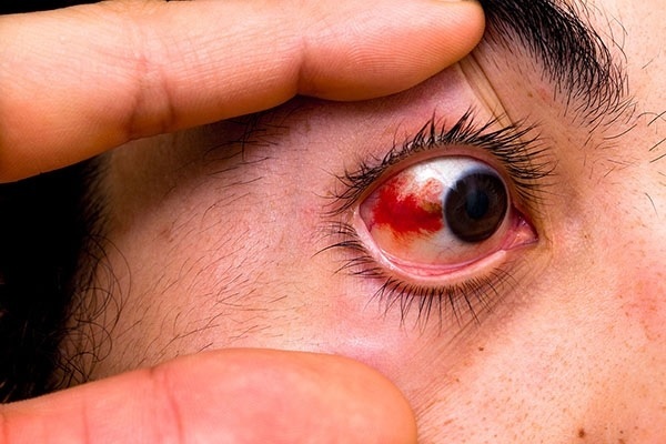 Red spots on the eyeball