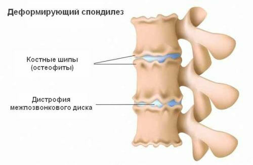 spondylose, la colonne vertébrale