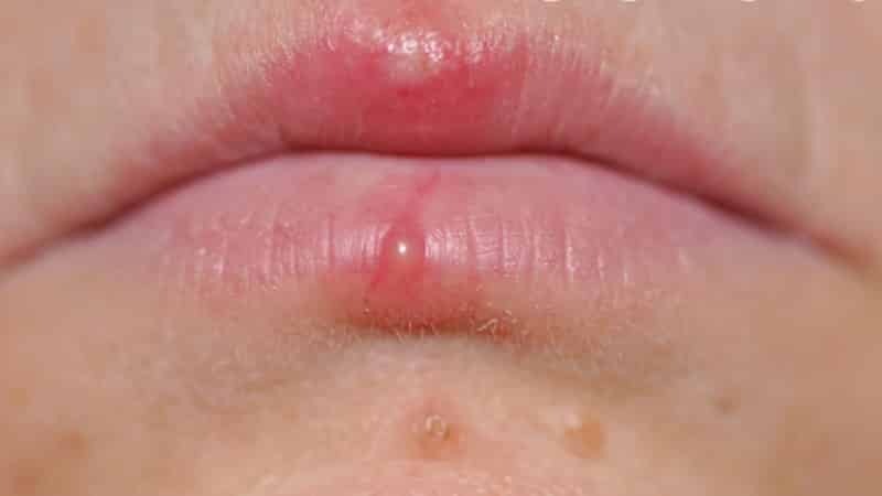 sieht aus wie Herpes auf den Lippen Photo Anfangsstadium