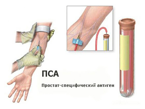 Las normas de antígeno prostático específico y libre( PSA)