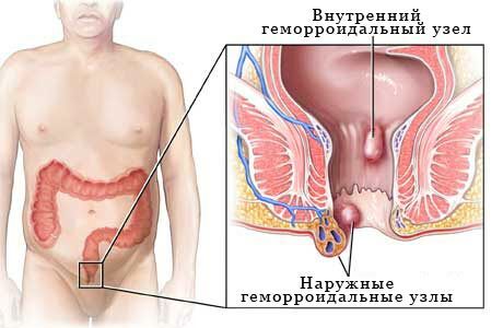 How to get rid of external nodes with hemorrhoids?