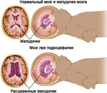 hjerne hydrocephalus