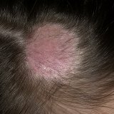 Microsporia van de hoofdhuid: symptomen, behandeling