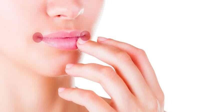 zašto pukotine se pojavljuju u kutovima usta uzrokuje liječenje