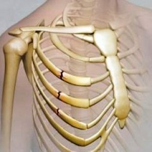 hoe-lang-helen-gebroken ribben