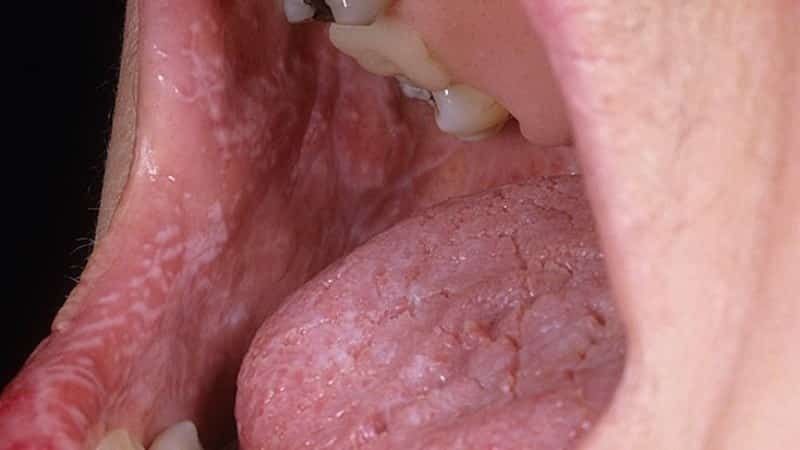 Lichen ruber in oralen Prophylaxe