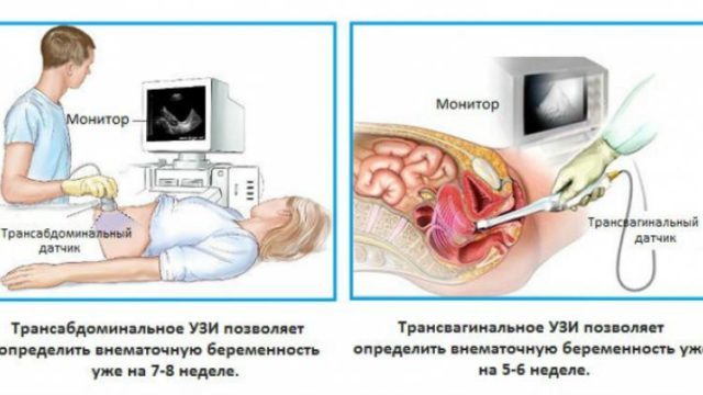 Features of the pelvic ultrasound in men