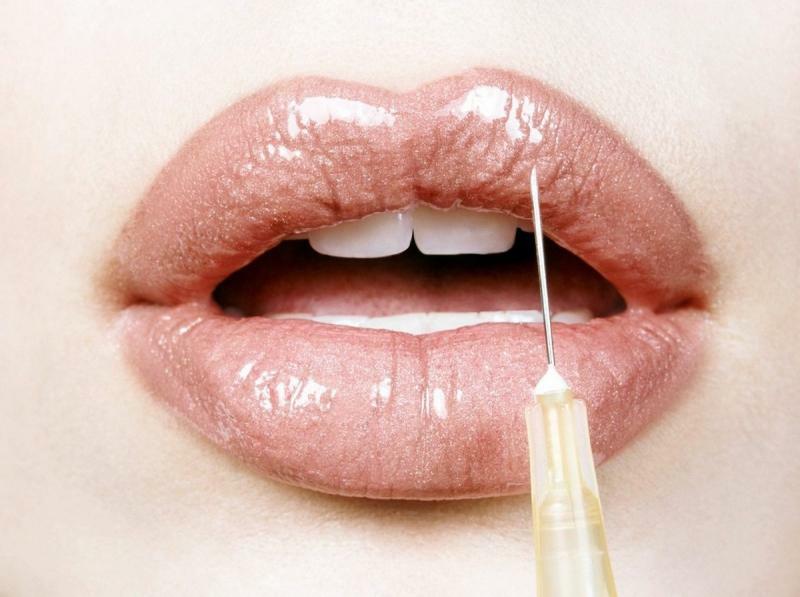 Was kann und kann nach der Lippenvergrößerung mit Hyaluronsäure nicht tun