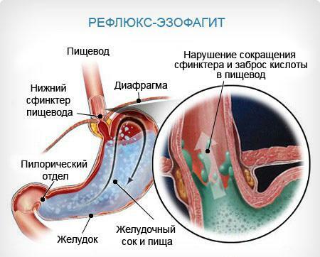 Distal esophagitis symptoms and treatment
