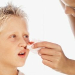 Hemorragia nasal em crianças