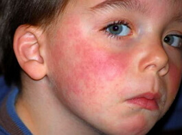 Allergische huiduitslag