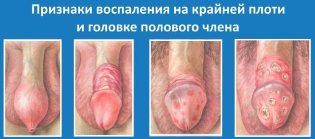 Basic disease of the penis