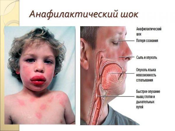 Sintomas de choque anafilático