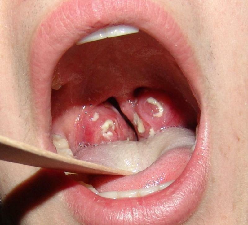 Ulcere sulle tonsille: immagine, sintomi e trattamento
