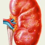 Treatment of kidney disease: nephritis