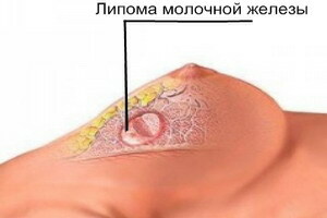 Lipoma of the breast in women