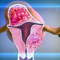 Contra-indicaties voor uterine myomen
