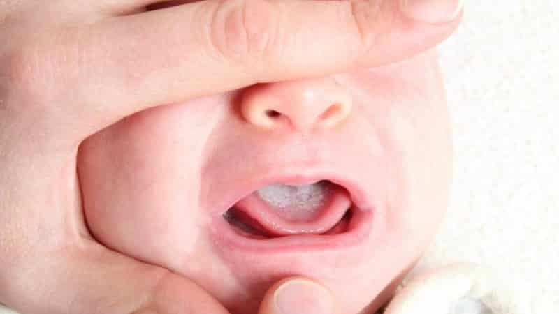 bijele mrlje u usta novorođenčeta