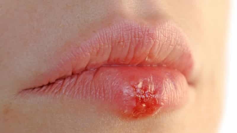 zapalenie jamy ustnej leczenie warga