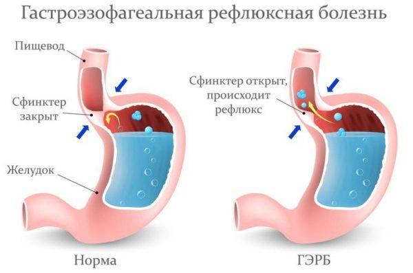Gastroezofagealna refluksna bolest (GERB)
