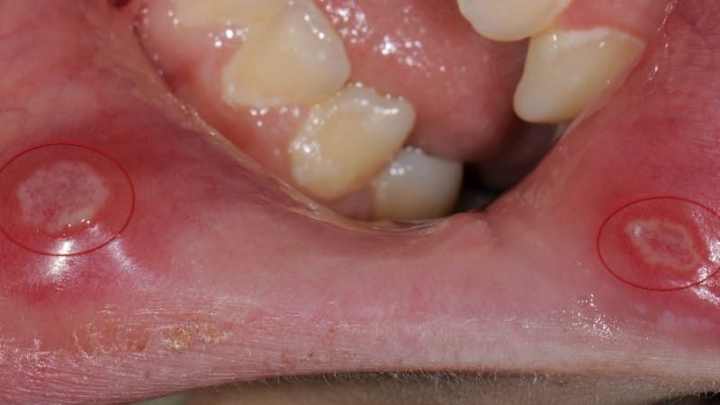 Jak długo są one traktowane jamy ustnej u dzieci i dorosłych: zwłaszcza terapia