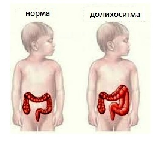 Dolihosigma - intestinal pathology