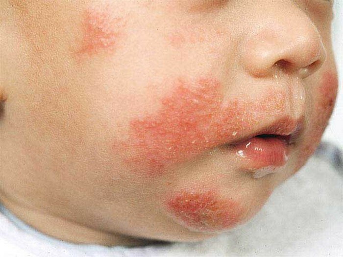 Eczema-y-children