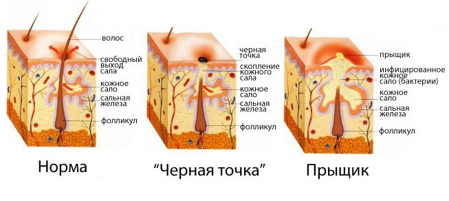 Akne og kviser på ryggen: årsakene til og måter behandling