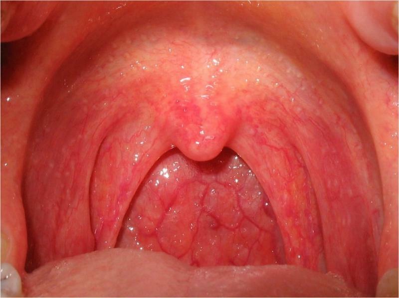 Traumatic stomatitis: treatment in adults and children