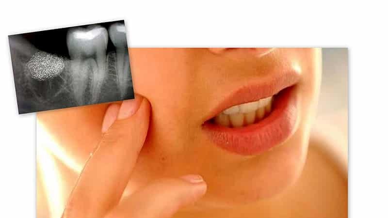 Orsakerna till sjukdomar i tandköttet