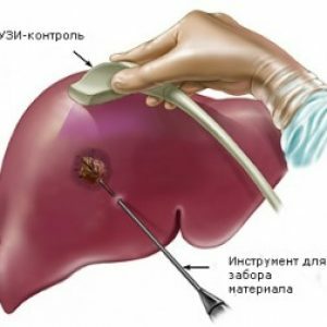 Liver cyst
